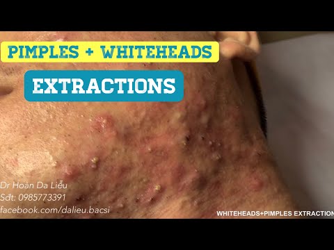 Nặn mụn nhọt vùng viền hàm siêu to nhiều mủ|Squeeze super big big pimples on the jawline, whiteheads