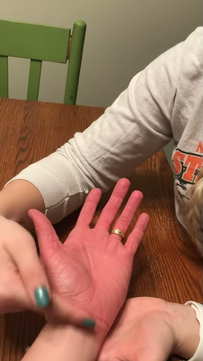 Tinel Sign CTS (median nerve)