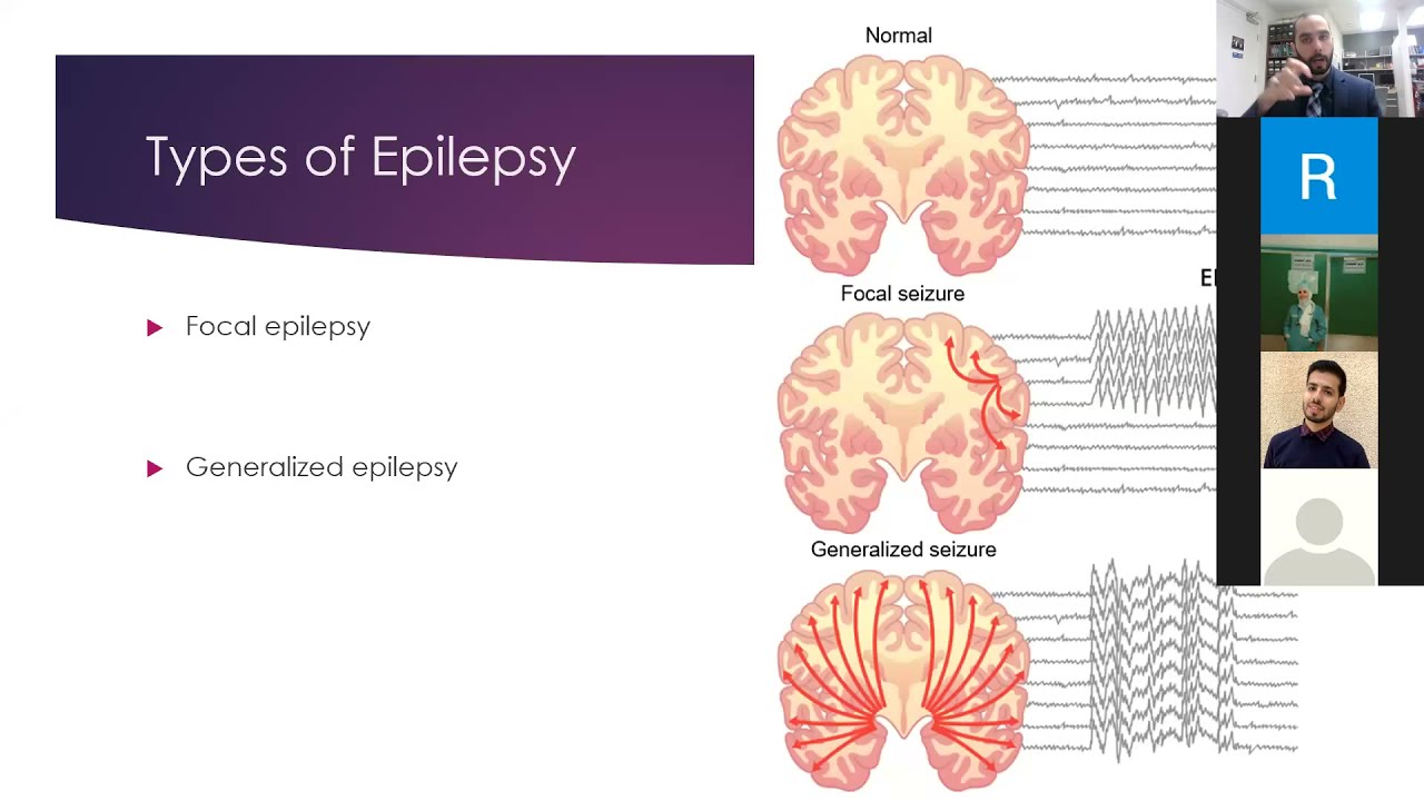 ما هو مرض الصرع وكيف يتم علاجه - محاضرة مفصلة لطلبة الطب