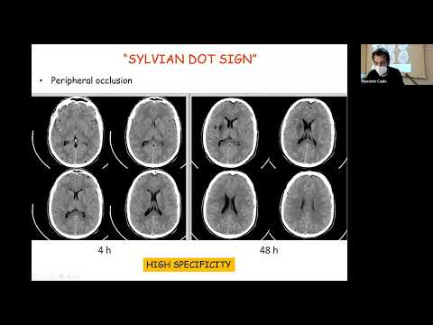 Video: Dov'è il simplex chronicus?