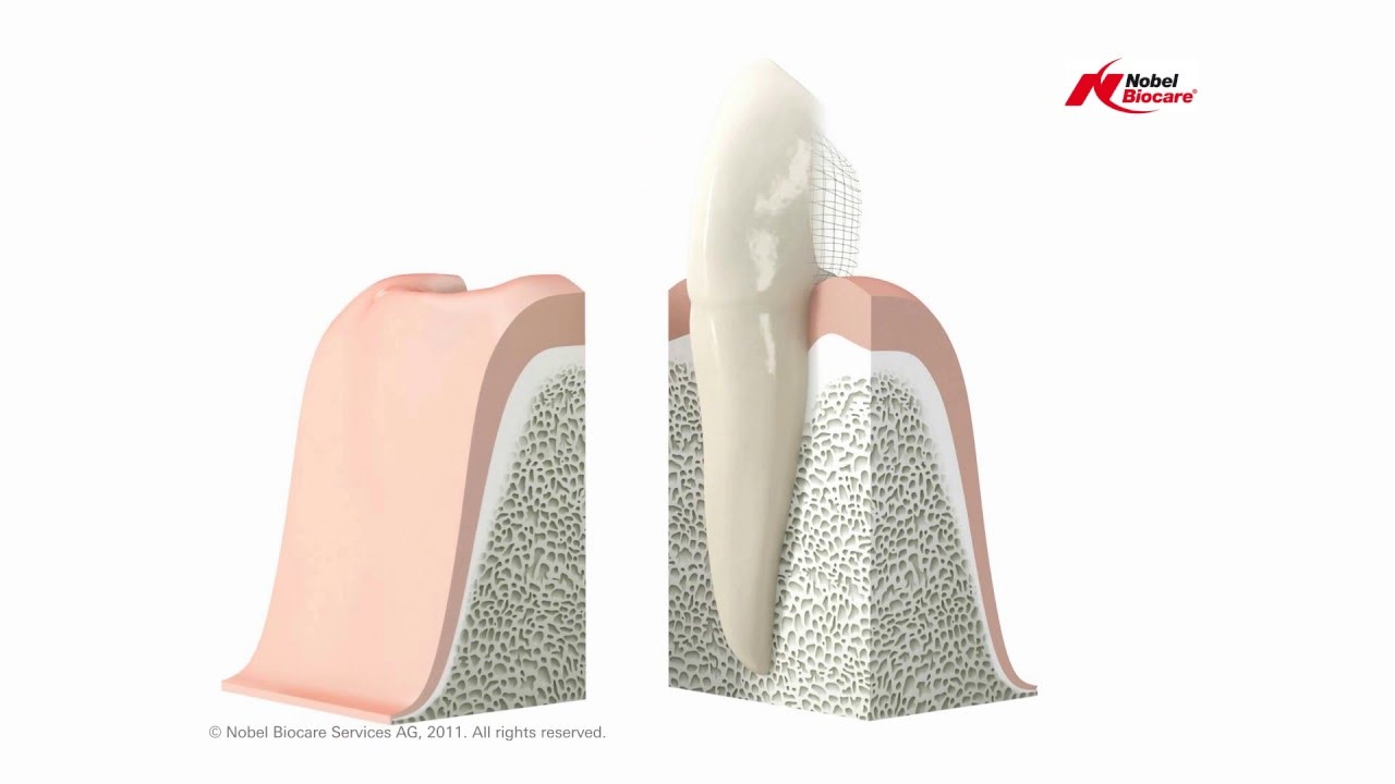 Coral Gables Dental Implants · Plantation Dental Implants