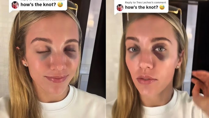 Lexie Hull injury update on her face after collision during the game 😳