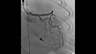 TIMI-III Flow in LAD & LCX with Less than 40% Residual Stenosis in Ostial LAD