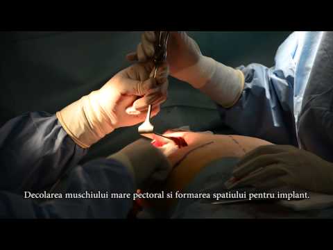 Video: Medicare Acoperire Pentru Mastectomie Dublă