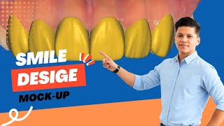 Orthodontic Mock-Up for Teeth 11–21 | Exocad Smile Design Tutorial | Ratanician