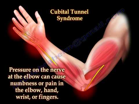 Video: Hur Man Behandlar Kubital Tunnelsyndrom + Orsaker Och övningar