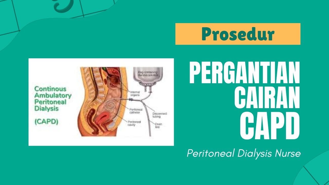 Pergantian Cairan CAPD (Continuous Ambulatory Peritoneal Dialysis ...