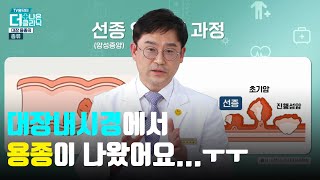 대장내시경 중 나온 '용종' 제거 안 하면 '암' 발병률 높인다고?