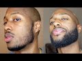 2 Year Beard Transformation Using Minoxidil