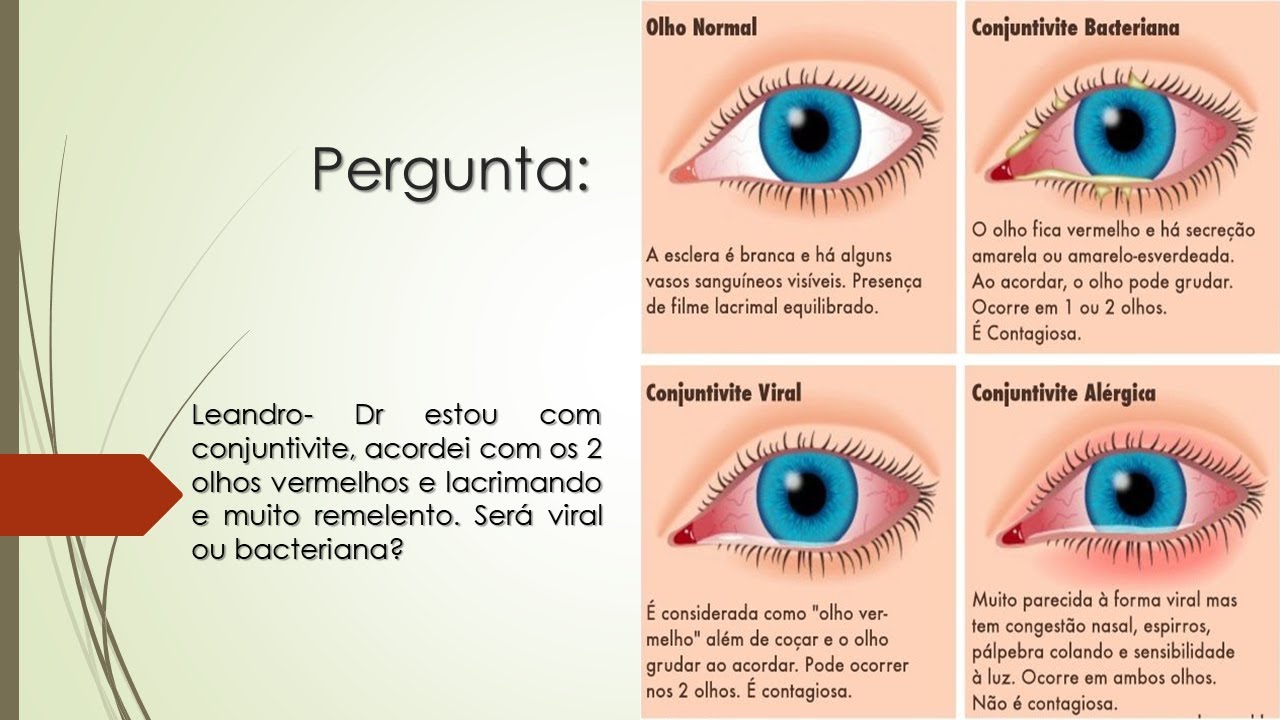 Estou com Conjuntivite | Acordei com os olhos vermelhos, lacrimando e ...