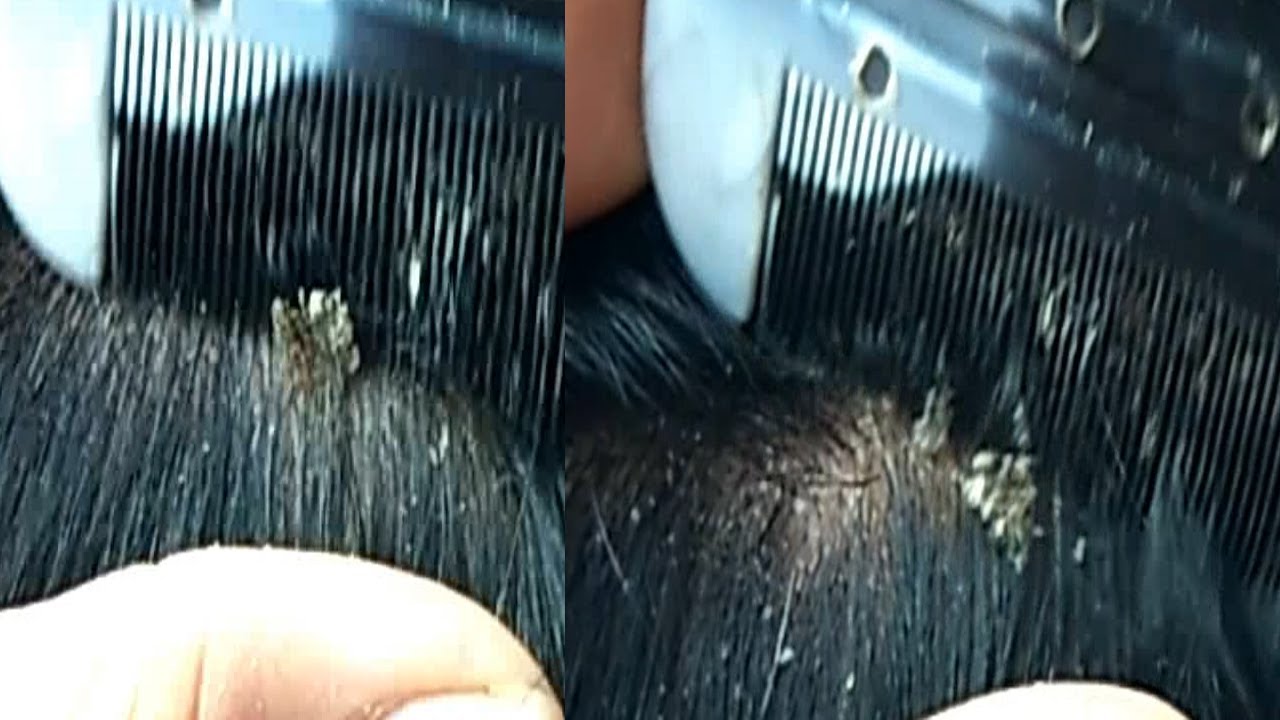 Dandruff Scratching Treatment Dandruff Scratching With Lice Comb