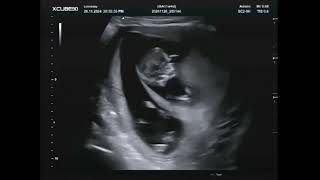 Pretecho 11 Weken Live Filmpje Tweeling