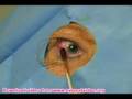 Intravitreal Injection Technique