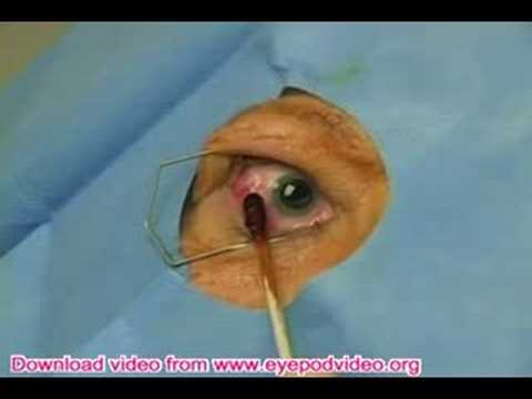 Intravitreal steroid injections