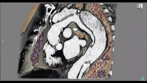 4D CT Aortic Dissection: 解離性大動脈瘤