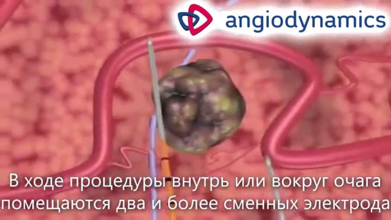 Лечение рака Нано ножом AngioDynamics
