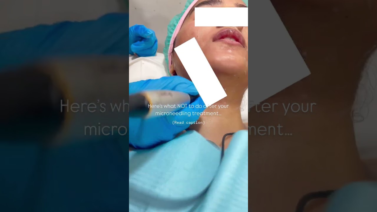 After micro needling Avoid from     1- direct contact with nd don't forget to put your sunscreen