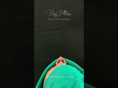 Video thumbnail: Correct A Very Asymmetrical Nose! Immediate Table Results · Dr. Philip Miller, MD, FACS