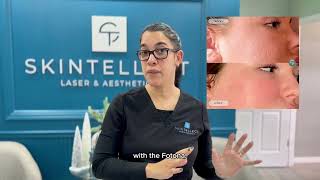 Co2 Laser Vs Fotona Erbium Laser Key Differences & Benefits Of Fotona Clearlase Skintellect Tampa