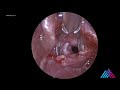 Supraglottoplasty and bronchoscopy for noisy breathing