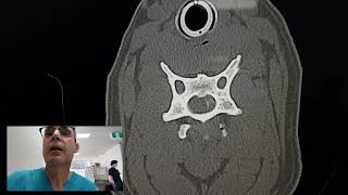 Short story - massive cervical disc rupture CT scan Wealth