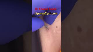 Blackhead Removal With Sac DepSpa #100077