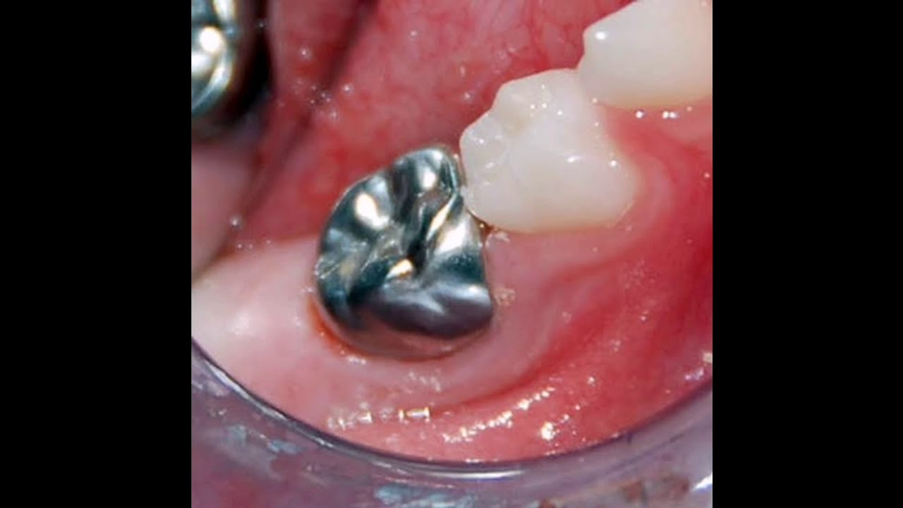 Coronas de acero cromo en dientes posteriores - YouTube