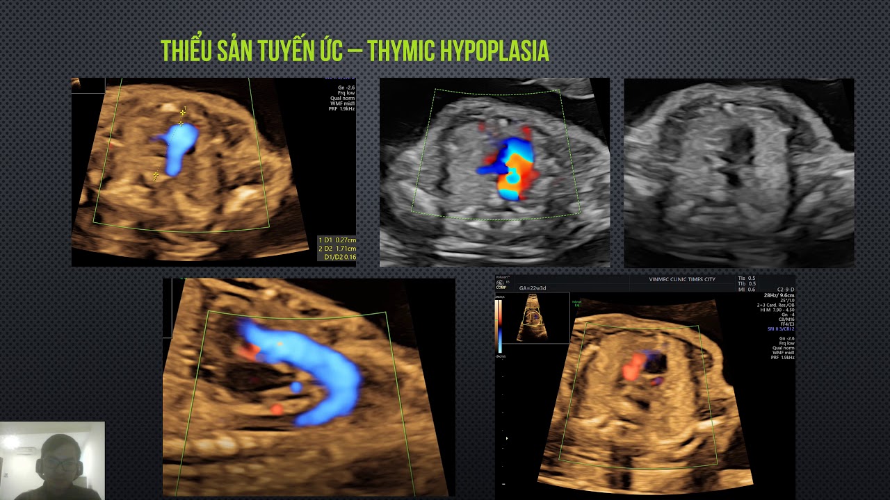 Chẩn đoán trước sinh hội chứng vi mất đoạn 22q11 2 - Digeorge Syndrome (thuyết minh)