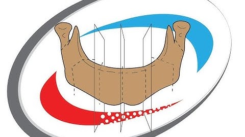 BoneReconstructionPlanner (Software tests)