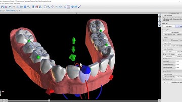 Virtual Tooth Placement