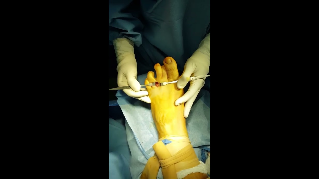 Cirugia de pie: Exeresis de neuroma de Morton - YouTube
