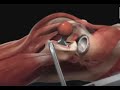 Эндопротезирование тазобедренного сустава: этапы операции, принципы и техника замены сустава