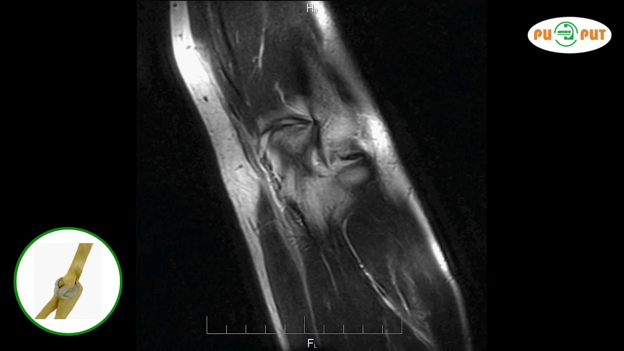 Что покажет МРТ локтевого сустава (снимки) видео