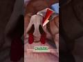 Stop a Nosebleed the Right Way (Most People Do This Wrong)