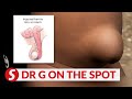 EP223: How does hernia affect one’s sexual health? | PUTTING DR G ON THE SPOT