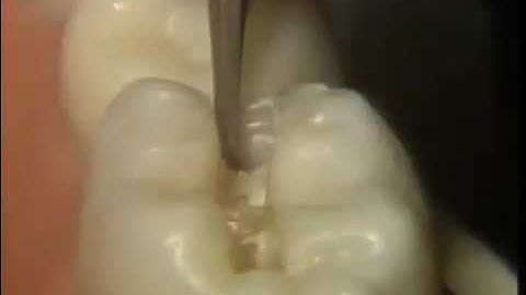The Amalgam Proximal Box Cavity Preparation