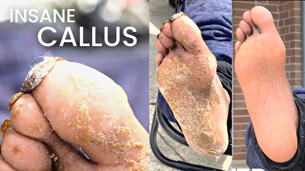 Callus Remover, Treat Your Feet to a Smoothing Luxury Pedicure