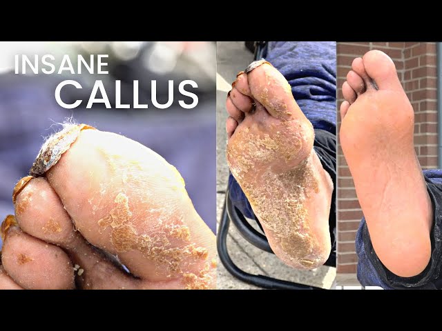 Callus Removal From Feet  Insane Pedicure 