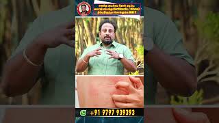 How to treat Hives (Urticaria) in Tamil ?
