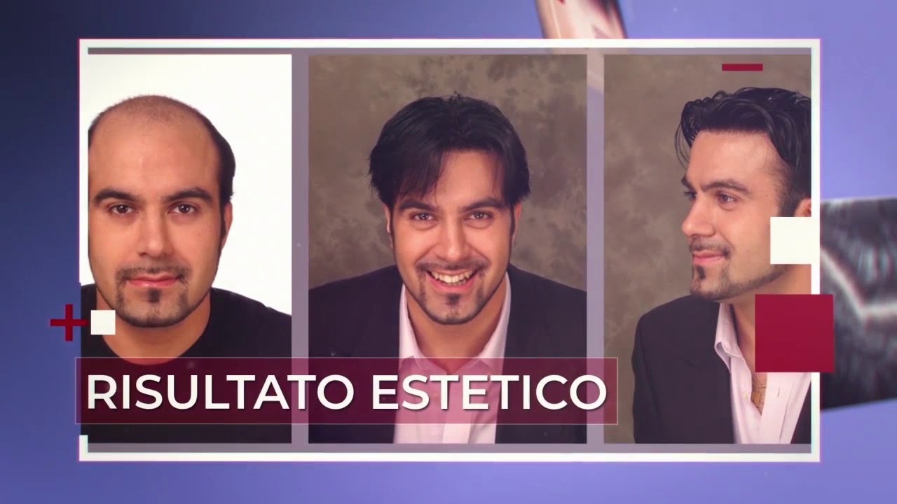 Rimozione e igienizzazione di UNA PROTESI PER CAPELLI - Turismo capelli a Roma