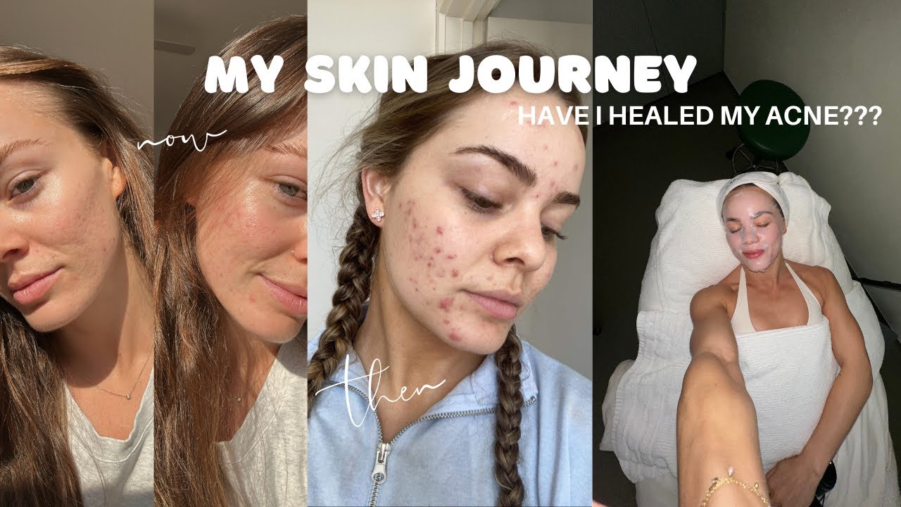 My skin journey | healing my acne after SIX years - YouTube