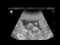 😻😻 УЗИ.12 недель. Монохориальная беременность-двойня. Ultrasound -twins.Поля и Даша в животике