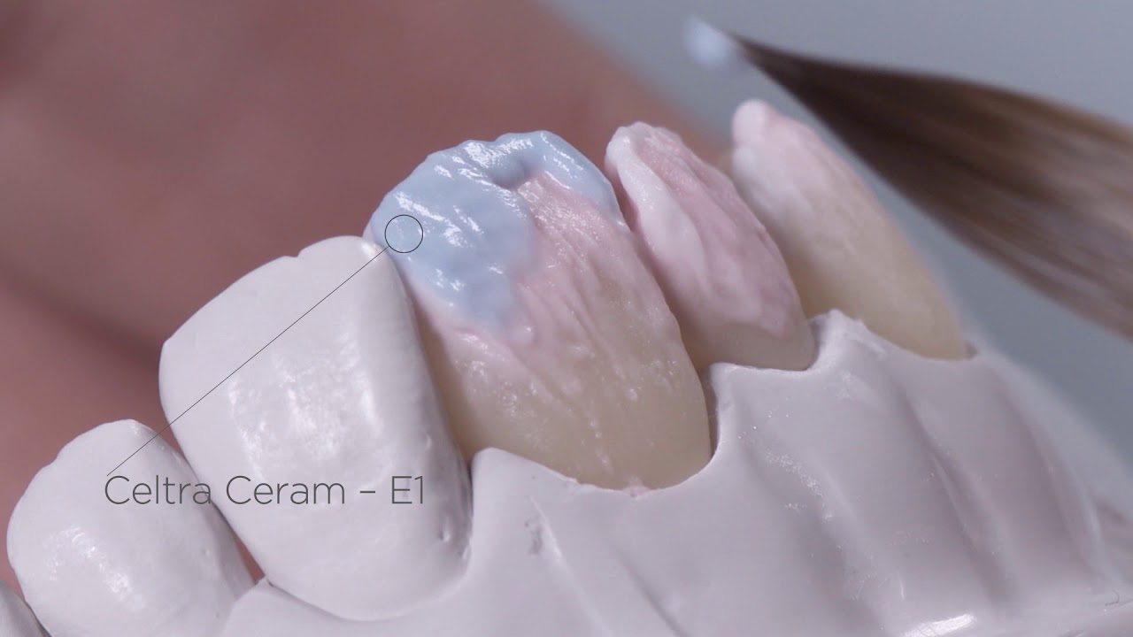 DS Lab Celtra Press fully veneered with Celtra Ceram