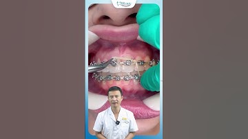 Móc Chun Đóng Khoảng Niềng Răng | Bác Sĩ Yên