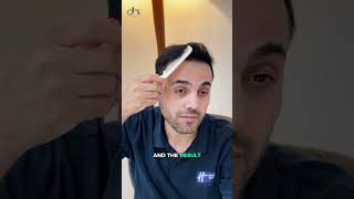 3,900 Grafts Hair Transplant | Natural Hairline & Incredible Result
