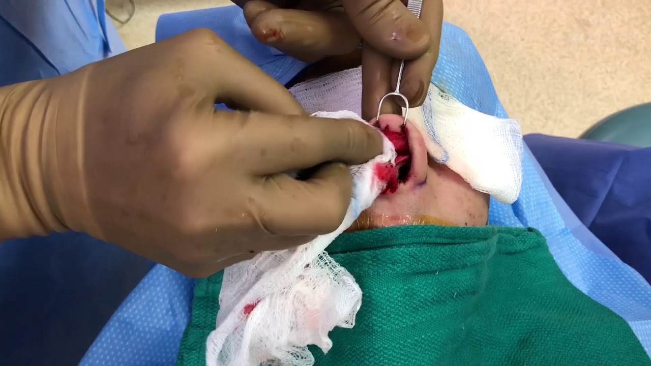 Nose Narrowing Limitations with Dr. Miller