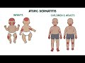 Atopic dermatitis (eczema) - causes, symptoms, diagnosis, treatment, pathology