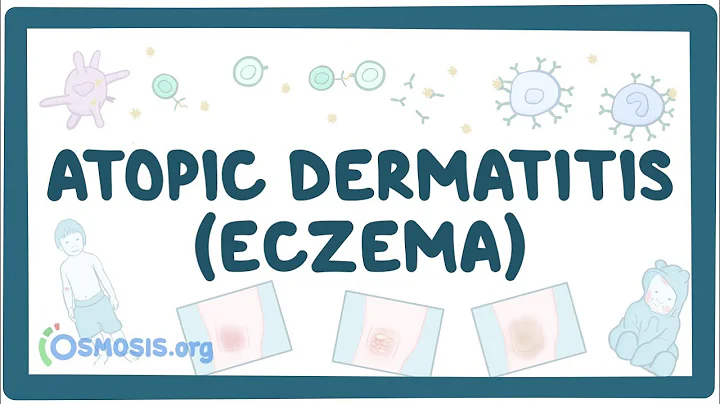 Atopic dermatitis (eczema) - causes, symptoms, diagnosis, treatment, pathology