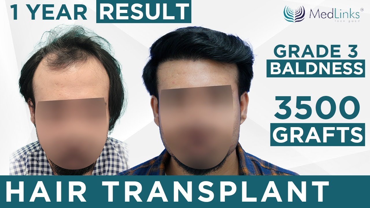 results-of-hair-transplant-surgery-3500-grafts-implants-grade-3