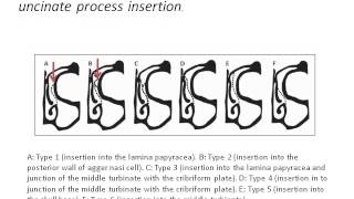 Uncinate Insertion Classification